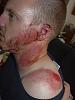 What's your worst ATV / Cycle injury???-accident-006.jpg